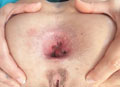 Rectal Feeding サンプル画像